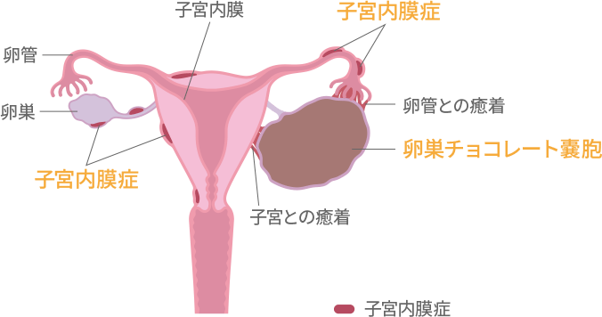 チョコレート嚢胞（卵巣内膜症性嚢胞）