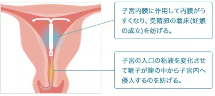 ミレーナの避妊効果