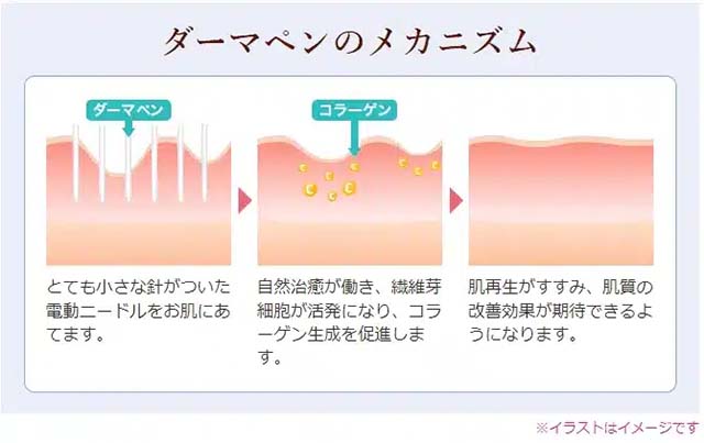 ダーマペンのメカニズム